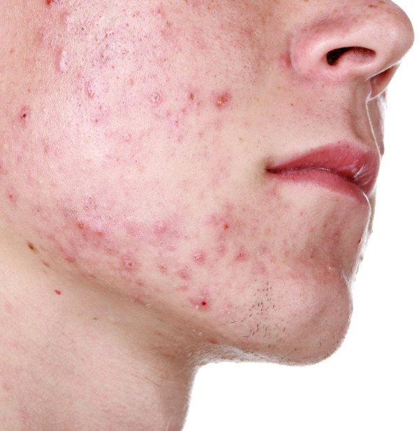 Acne Condition