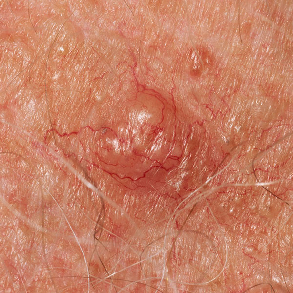 Basal Cell Carcinoma (BCC)