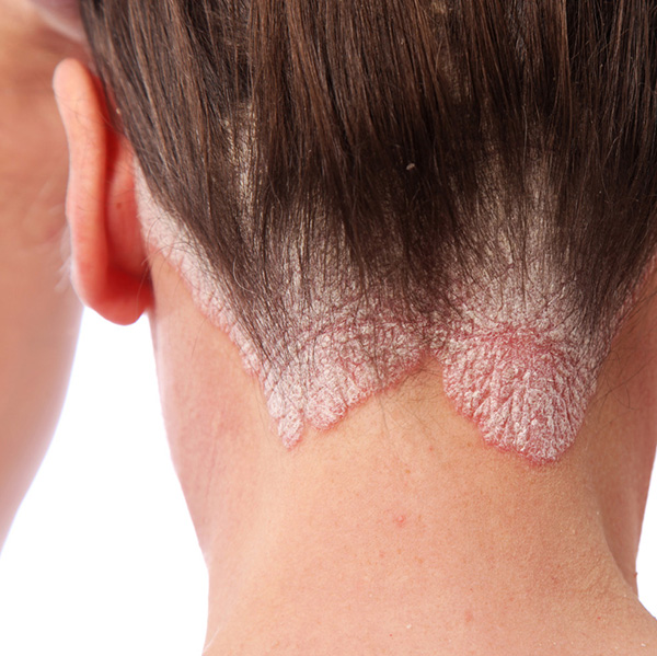 Psoriasis