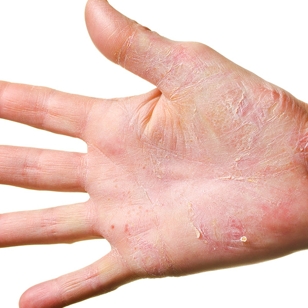 Eczema