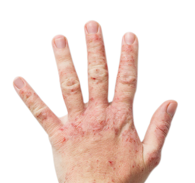 Atopic Eczema, also known as Dermatitis