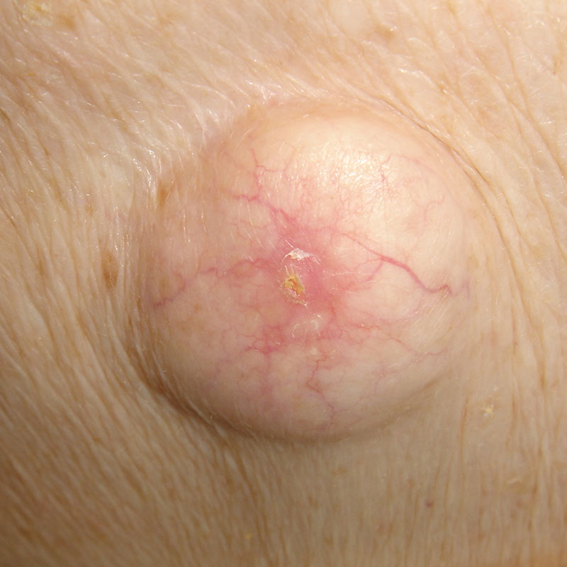 Epidermoid and Pilar Cysts
