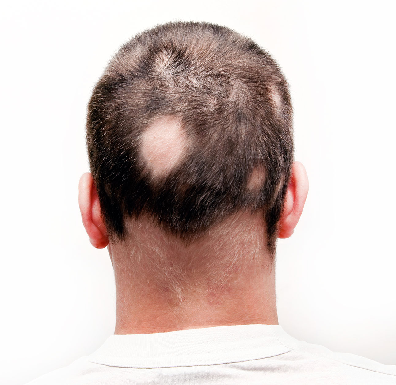 Alopecia Areata