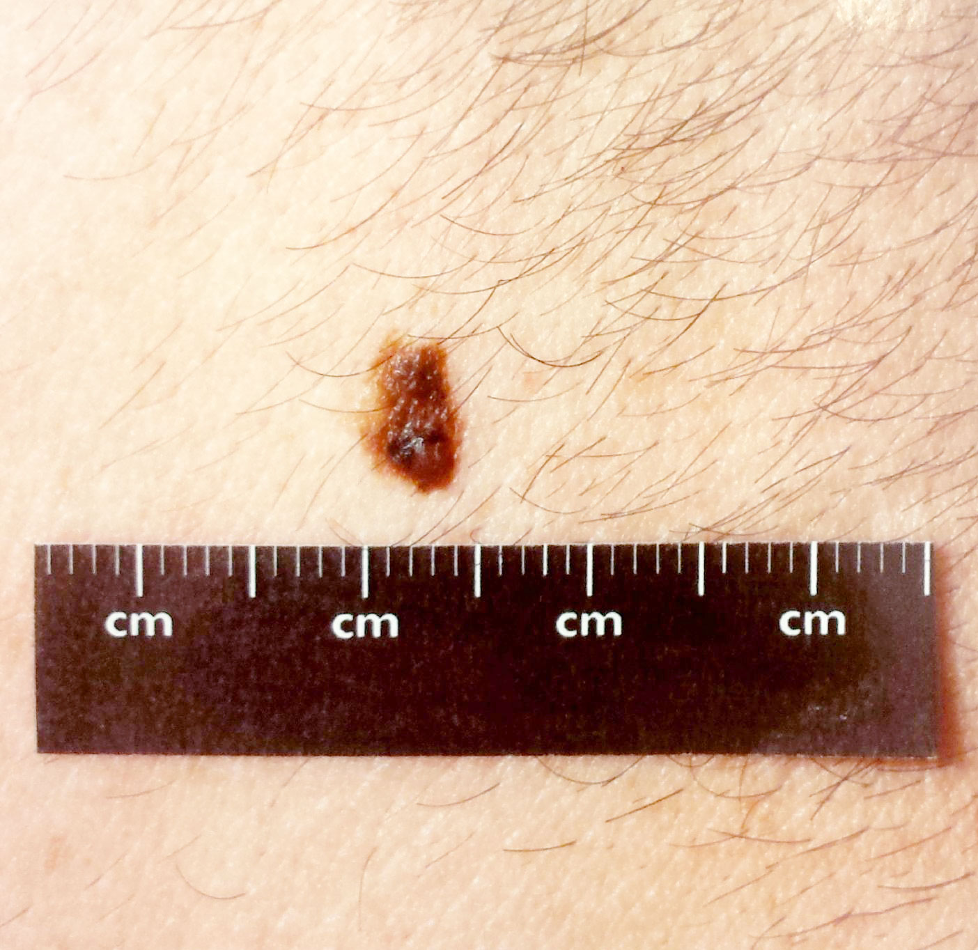 Skin Cancer