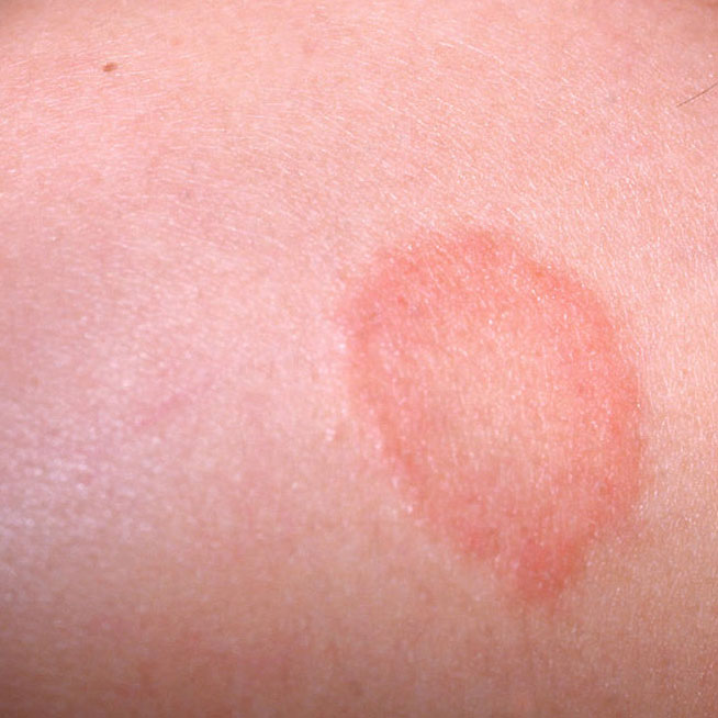 Ringworm